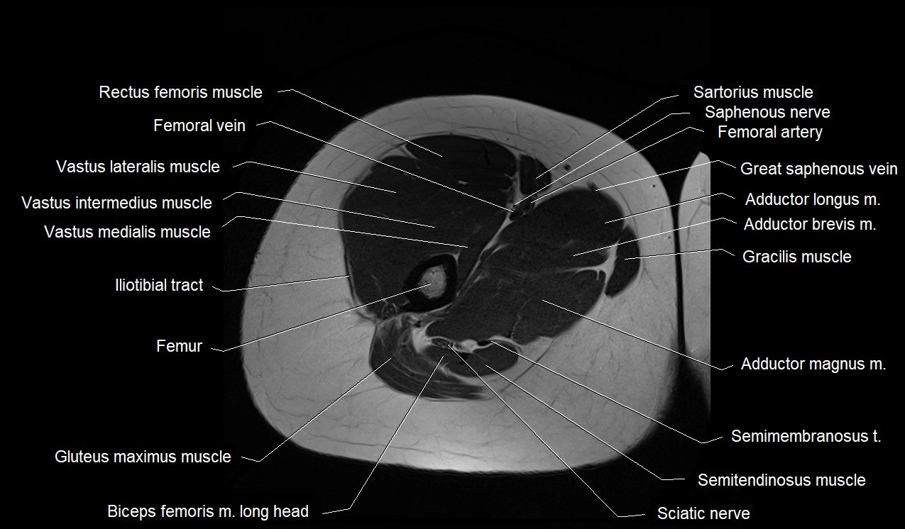 MRI thigh cross sectional anatomy image 20.webp